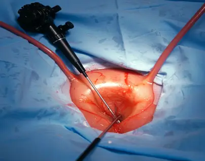 medical cystoscopy procedure scene showing cystoscope insertion into bladder, sterile drape visible